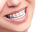 this is picture of braces saini Dental Clinic best detal clinic in jalandhar