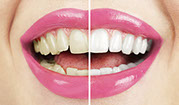 this is picture of tooth whitening saini Dental Clinic best detal clinic in jalandhar