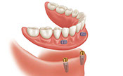 this is picture of dentures Saini Dental Clinic best detal clinic in jalandhar