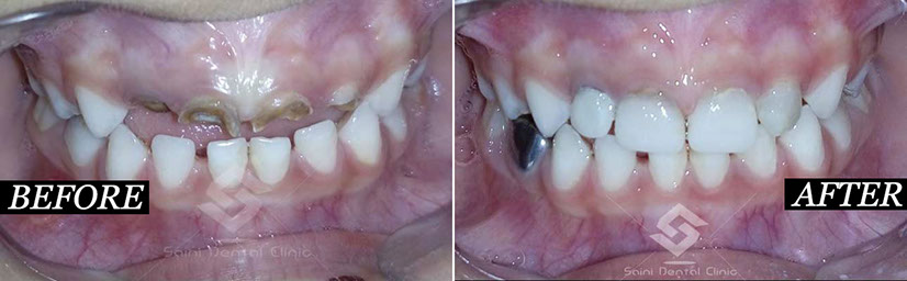 this is a Image of change of tooth 1 at saini dental clinic best dental clinic in jalandhar