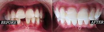 this is a Image of change of tooth 2 at saini dental clinic best dental clinic in jalandhar