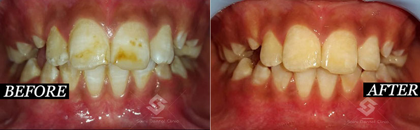 this is a Image of change of tooth 3 at saini dental clinic best dental clinic in jalandhar