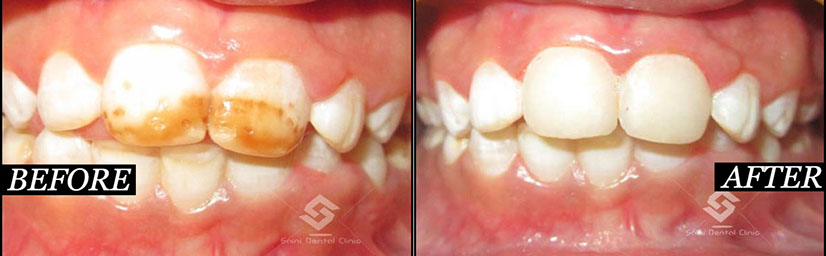 this is a Image of change of tooth 5 at saini dental clinic best dental clinic in jalandhar