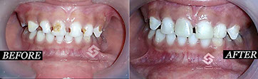 this is a Image of change of tooth 5 at saini dental clinic best dental clinic in jalandhar