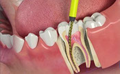 this is picture of RCT Saini Dental Clinic best detal clinic in jalandhar